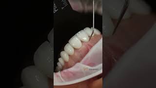 Try in before cementation dentist dentistry dental dentalclinic dentalcare trendingshorts [upl. by Allerbag727]