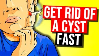 How to Get Rid of a Cyst in 2024 [upl. by Benildas]