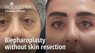 Blepharoplasty without skin resection  23237 [upl. by Goldfarb]