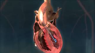 Impella CP® Heart Pump Animation [upl. by Elsi]