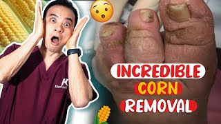 CUTE Corn Removal on Toe  HACK to Reduce Foot Swelling With Apple Cider Vinegar [upl. by Bruner568]