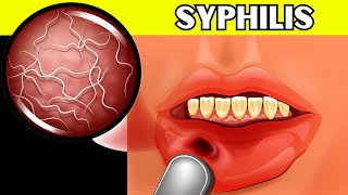 Syphilis  Causes Signs amp Symptoms Pathogenesis Diagnosis And Treatment [upl. by Anama837]