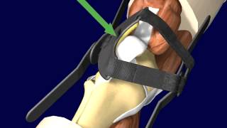 PTO Patellar Tracking Orthosis Knee Brace Directions and Application [upl. by Frulla]