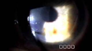 Slit Lamp Techniques  Corneal Epithelium [upl. by Seeto]