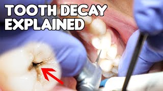 Tooth Decay Cavity Explained  Cavities vs Fillings vs Dental Caries [upl. by Petronella907]