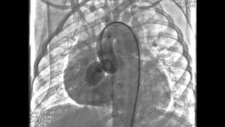 Transcatheter plug embolisation of Coronary cameral fistula with PDA device closure [upl. by Kcirdor26]