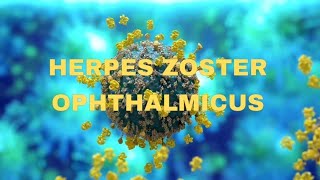 Herpes zoster ophthalmicus  OPHTHALMOLOGY  NEETPG  virus  keratitis [upl. by Satterlee]