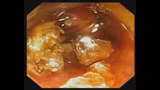 Direct Peroral Cholangioscopy with Electrohydraulic Lithotripsy for Cystic Duct Stone [upl. by Sunderland608]