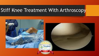 How is Arthroscopic Treatment of Stiff Knee Preformed Knee Arthrolysis [upl. by Ennybor]