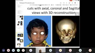 Plastiquest Case Discussion TMJ Ankylosis [upl. by Akihsay]