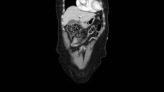 transverse colon cancer [upl. by Gray]