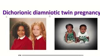 Anatomy of dichorionic and diamniotic twin pregnancy with sonographic feature twin obimagesnet [upl. by Nnyled376]