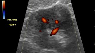 Echogenic renal mass renal cell carcinoma or Angiomyolipoma Ultrasound and color Doppler video [upl. by Oiromed]