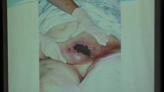 UNC VIDEOS calcified Uremic Arteriolopathy Calciphylaxis Dr Mohamed Sobh [upl. by Wilkinson]