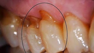 attrition and abrasionتأكل الاسنان شنو اسبابه وشلون نكدر نعالجه ؟ [upl. by Kauppi]