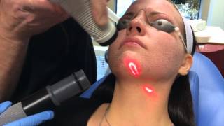 Recovery After CO2 Laser Facial [upl. by Nonnaer]