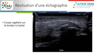 Rupture du tendon distal du triceps brachial chez une joueuse de basketball de 16ans [upl. by Rokach]