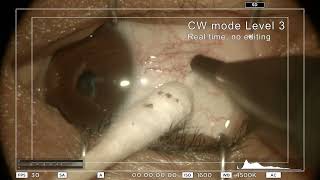 Conjunctival Nevus treatment Realtime No editing [upl. by Gotcher]