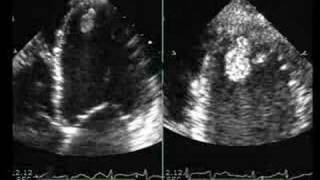 Dilated Cardiomyopathy with Mural Thrombus [upl. by Barbur]