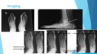 Foot and ankle 1PTTD posterior tibial tendon dysfunction AAFD adult acquired flatfoot deformity [upl. by Gratia]