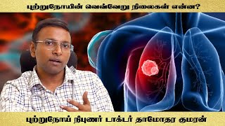 Stages of cancer  புற்றுநோயின் வெவ்வேறு நிலைகள் என்ன Dr Damodara kumaran [upl. by Ultann]