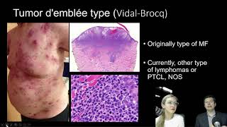 Tumor mycosis fungoides practical approach [upl. by Sacksen770]