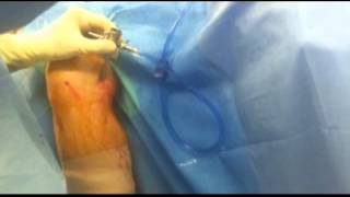 Arthroscopic Excision of Bakers Cyst JF Meyers M D [upl. by Esilana]