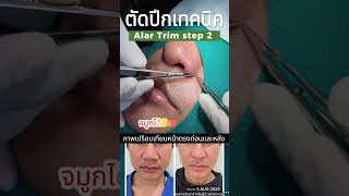 ตัดปีกจมูก alar trim หมอเปิ้ล [upl. by Ludeman]