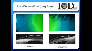 Scleral Contact Lenses Video 5 [upl. by Nimocks]