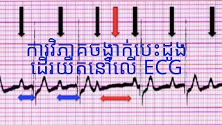 ECG Bradycardia  ការវិភាគចង្វាក់បេះដូងដើរយឺតនៅលើ ECG [upl. by Trabue]