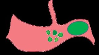 AFE Amniotic Fluid Embolism amp PTE Pulmonary Thromboembolism in Pregnancy [upl. by Layla]