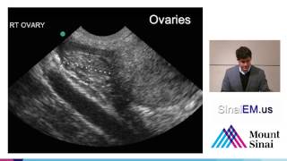 10 Ectopic Pregnancy [upl. by Ennazus]