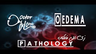 Oedema  pathology زي اللي فالكتاب  Doctor HOopa [upl. by Ivel215]