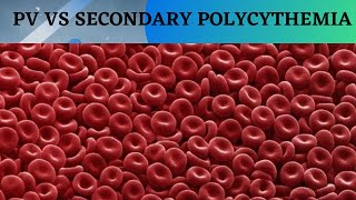 POLYCYTHEMIA VERA VS SECONDARY POLYCYTHEMIA [upl. by Yde]