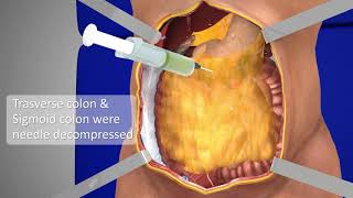 Exploratory Laparotomy  3D Medical Animation  Part  1  Films Blueray [upl. by Assirehs678]