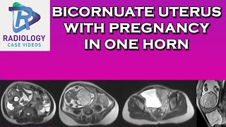 Bicornuate uterus with pregnancy in one horn [upl. by Llecrad]