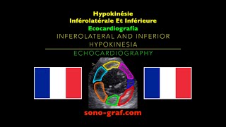 Échocardiographie  Hypokinésie Inférolatérale Et Inférieure [upl. by Hutchinson]