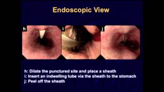 S079 A new procedure of esophagostomy for endoscopic surgeons  SS14 Therapeutic Endoscopy [upl. by Penelope]