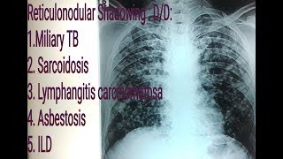 Reticulonodular shadowingopacity on Chest X Ray  Miliary Tuberculosis VS Sarcoidosis [upl. by Michi]