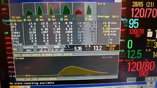 Cardiac output the longer version [upl. by Onitram]