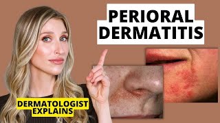 Dermatologist Explains Perioral Dermatitis What it Looks Like Causes amp Treatments  Dr Sam Ellis [upl. by Kingston]