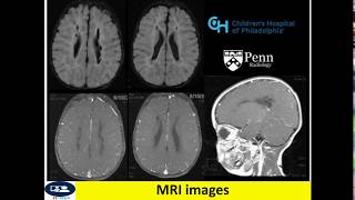 Periventricular leukomalacia in CT and MRI [upl. by Leiuqeze]