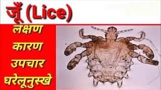 जूँ ka assan ilaj in hindi  easy treatment of lice in hindi  causes  home remedy [upl. by Leamhsi475]