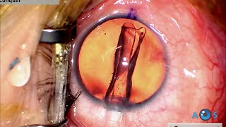 Visian ICL EVO Toric for High Myopic Astigmatism Lens Loading and Surgical Technique Guide [upl. by Edualc386]