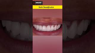 Microdontia  Yellow Stained Teeth  Gummy Smile  Tilted Incisor Treatment shorts dentist viral [upl. by Elmajian]