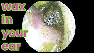 Ear pickingasmr ear cleaningwax in your earEar healthear piercing cleaninghow to unclog yourear [upl. by Ahsiened36]