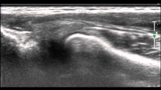 Ultrasonographic diagnosis of snapping annular ligament in the elbow [upl. by Olmsted]