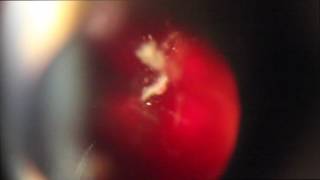 Laser Floater Removal  Titrating Coaxial lllumination by Dr Paul Singh [upl. by Ennayar333]