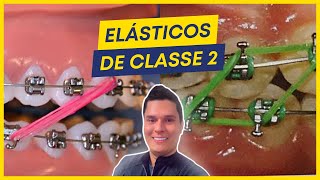 COMO TRATAR A CLASSE 2 COM ELÁSTICOS PASSO A PASSO [upl. by Ainevul]