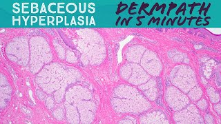 Stubborn Sac and Cyst Removal  CONTOUR DERMATOLOGY [upl. by Yrennalf806]